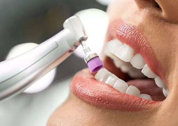 Closeup of mouth with teeth being polished.